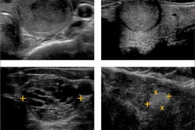 nodulo tiroideo benigno diagnostico y aspectos clave a conocer