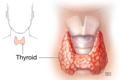 nodulo tiroideo definicion e implicaciones en la salud