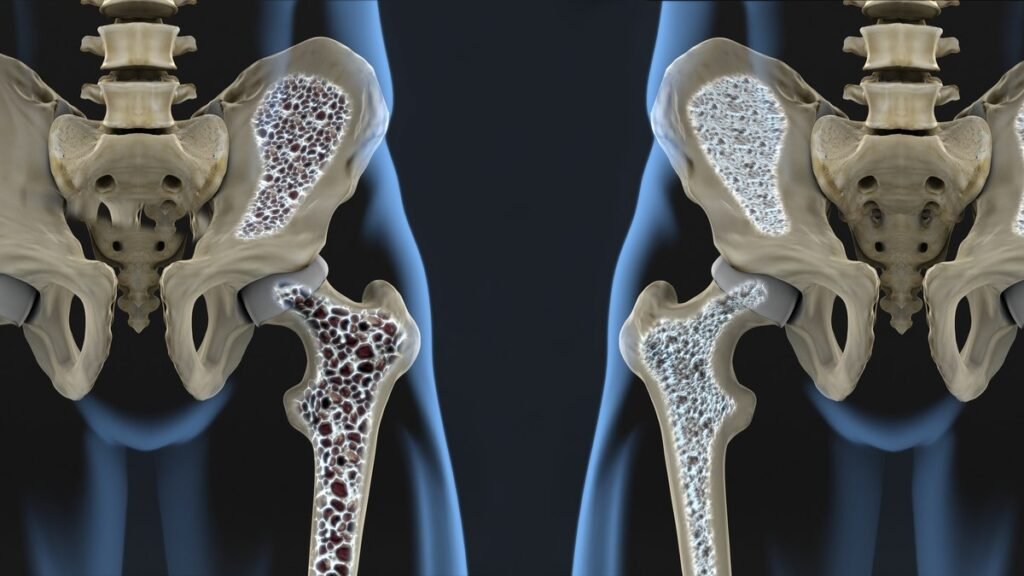 osteoporosis diagnostico y su impacto en la salud expuestos