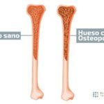 osteoporosis en adultos mayores causas sintomas y prevencion