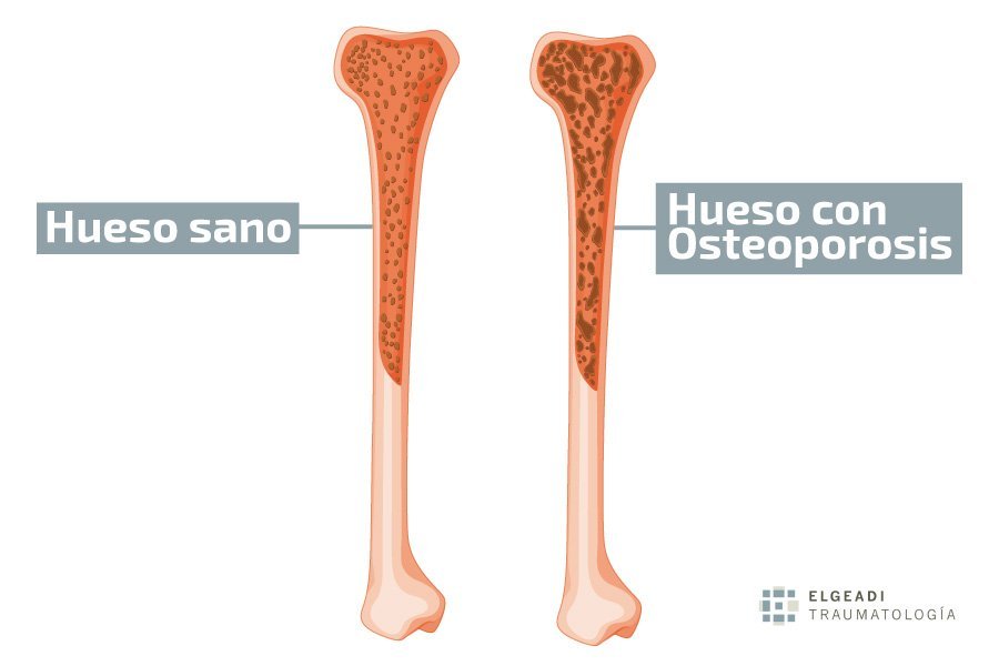 osteoporosis en hombres causas sintomas y tratamientos efectivos