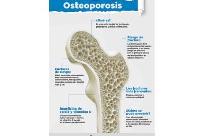 osteoporosis y condiciones autoinmunes conexion y cuidados necesarios