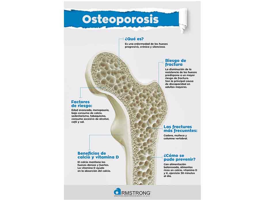 osteoporosis y condiciones autoinmunes conexion y cuidados necesarios