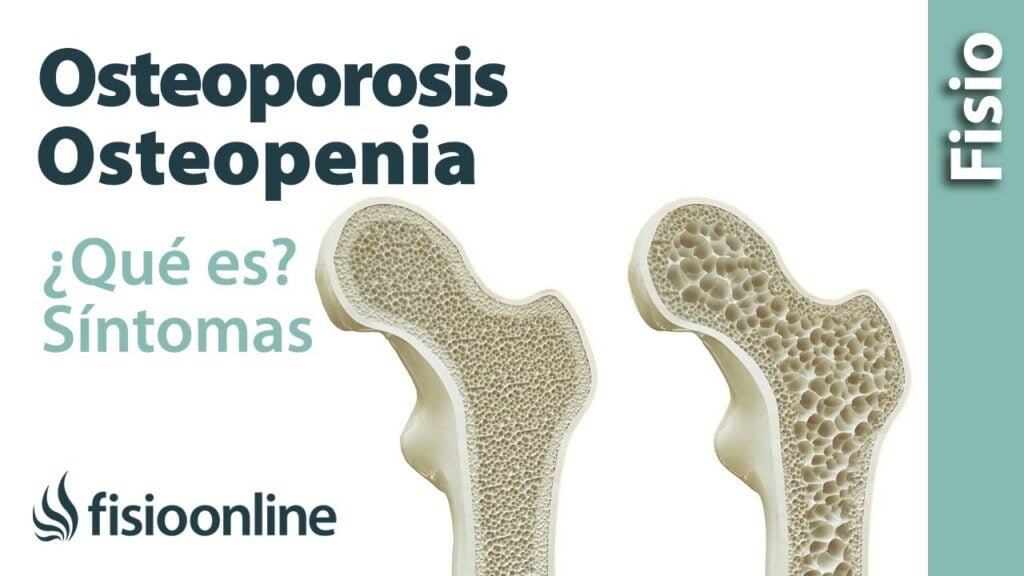 osteoporosis y osteopenia diferencias clave que debes conocer