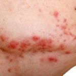 puede la progesterona ayudar en el tratamiento del acne