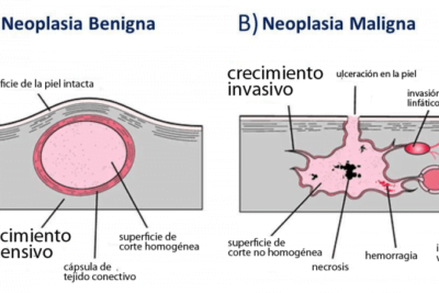que diferencias hay entre tumores benignos y malignos