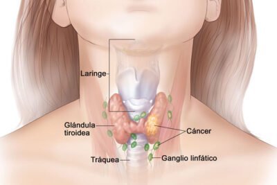 que es el cancer de tiroides y como afecta la salud