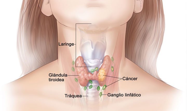 que es el cancer de tiroides y como afecta la salud