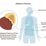 que es el hipocortisolismo y cuales son sus causas y sintomas