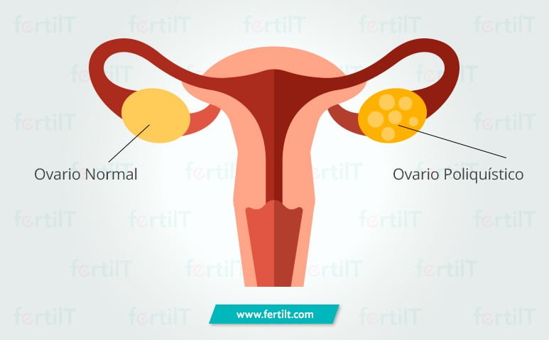 Qué es el síndrome de ovario poliquístico (SOP) 1 que es el sindrome de ovario poliquistico sop