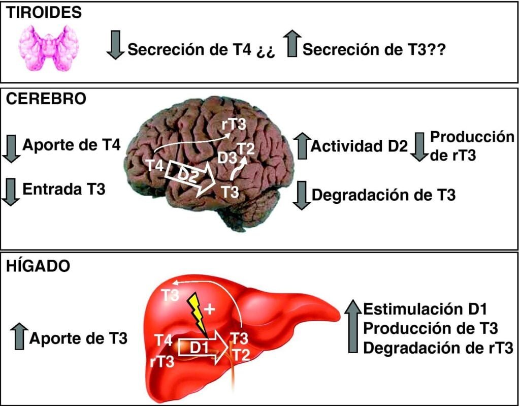 Qué es el síndrome de resistencia a hormonas tiroideas 1 que es el sindrome de resistencia a hormonas tiroideas