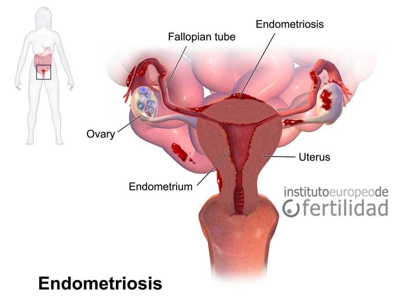 que es la endometriosis y como afecta la fertilidad