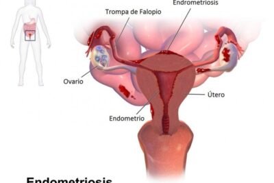 que es la endometriosis y su relacion con los estrogenos