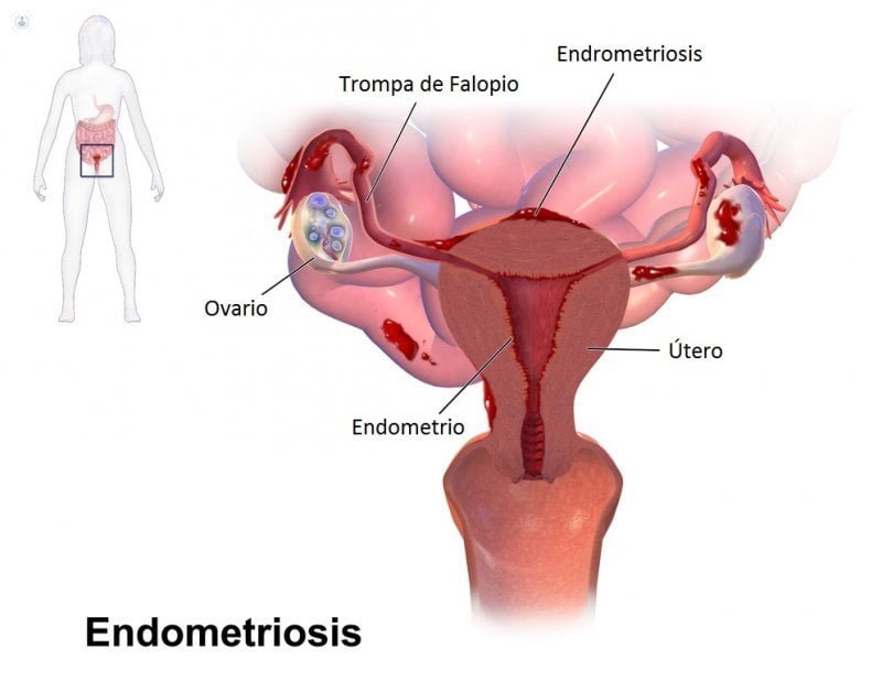 que es la endometriosis y su relacion con los estrogenos