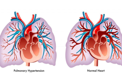 que es la hipertension pulmonar y cuales son sus causas y sintomas