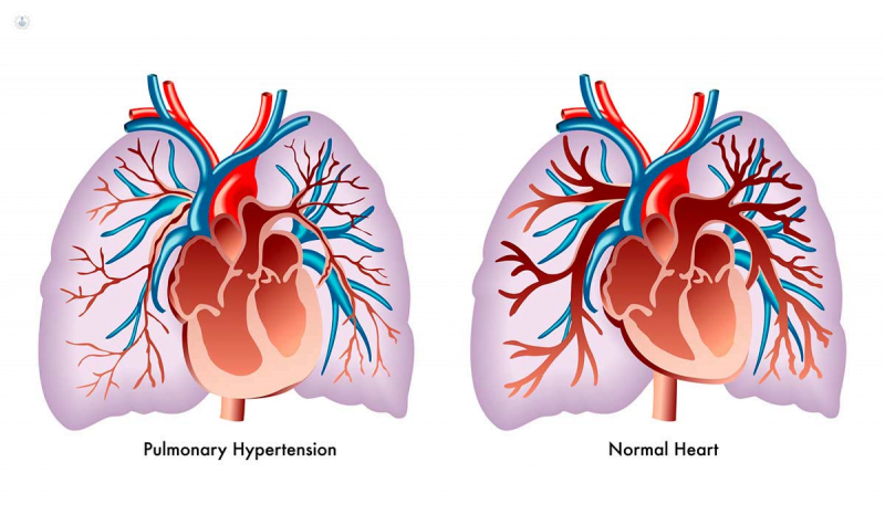 que es la hipertension pulmonar y cuales son sus causas y sintomas