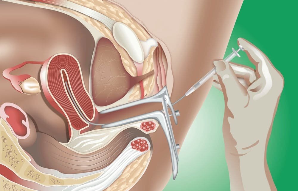 que es la tecnica de inseminacion intrauterina iiu