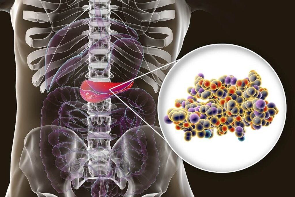 Qué tiene que ver la hipoglucemia con la insulinoma 1 que tiene que ver la hipoglucemia con la insulinoma