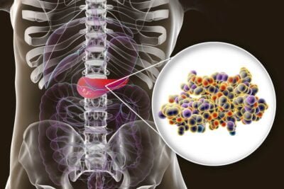 que tiene que ver la hipoglucemia con la insulinoma
