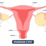 Quistes hormonales: todo lo que necesitas saber y su impacto