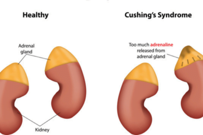 rol de las glandulas suprarrenales en el sindrome de cushing