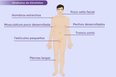 sindrome de klinefelter definicion y relacion con hormonas
