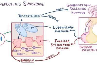 sindrome de klinefelter relacion con las hormonas explicada