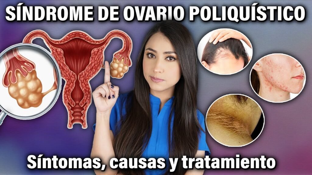 sindrome de ovario poliquistico causas sintomas y tratamiento