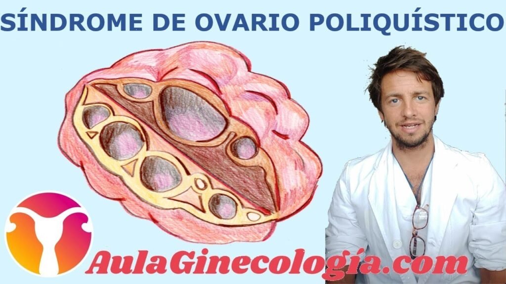 Síndrome de ovario poliquístico: causas y síntomas explicados 1 sindrome de ovario poliquistico causas y sintomas explicados