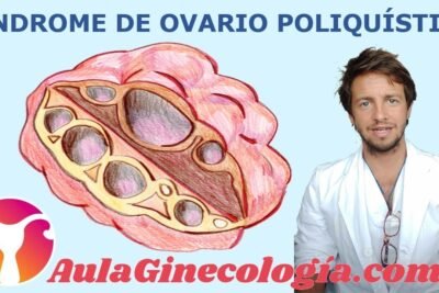 sindrome de ovario poliquistico causas y sintomas explicados