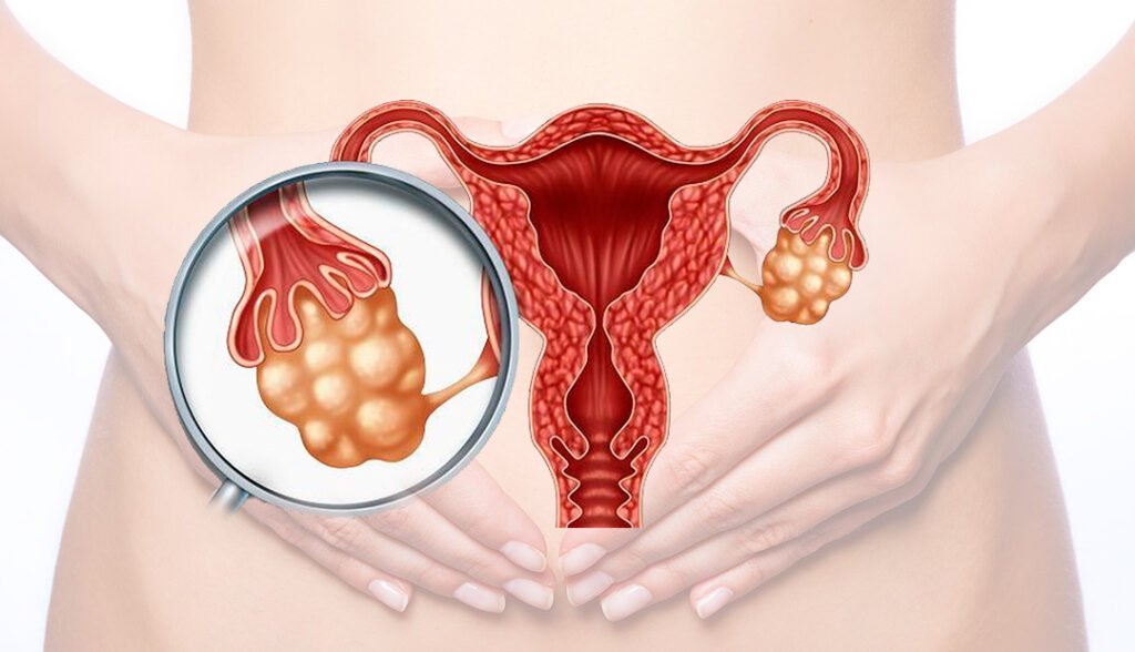 Síndrome de ovario poliquístico y su vínculo con desequilibrios hormonales 1 sindrome de ovario poliquistico y su vinculo con desequilibrios hormonales