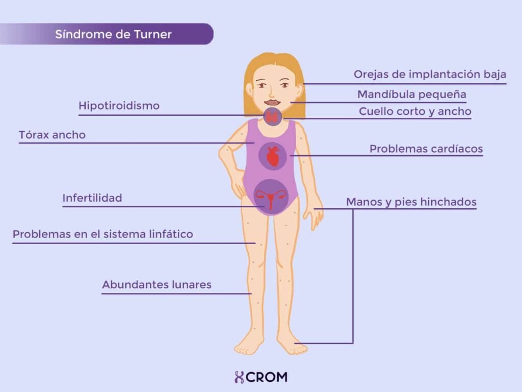 Síndrome de Turner: definición e impacto hormonal en la salud 1 sindrome de turner definicion e impacto hormonal en la salud