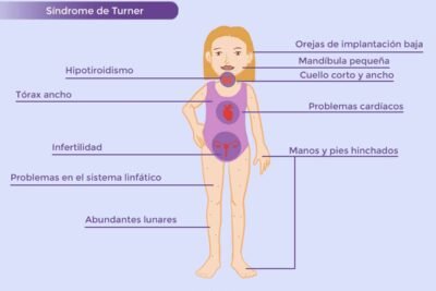 sindrome de turner definicion e impacto hormonal en la salud