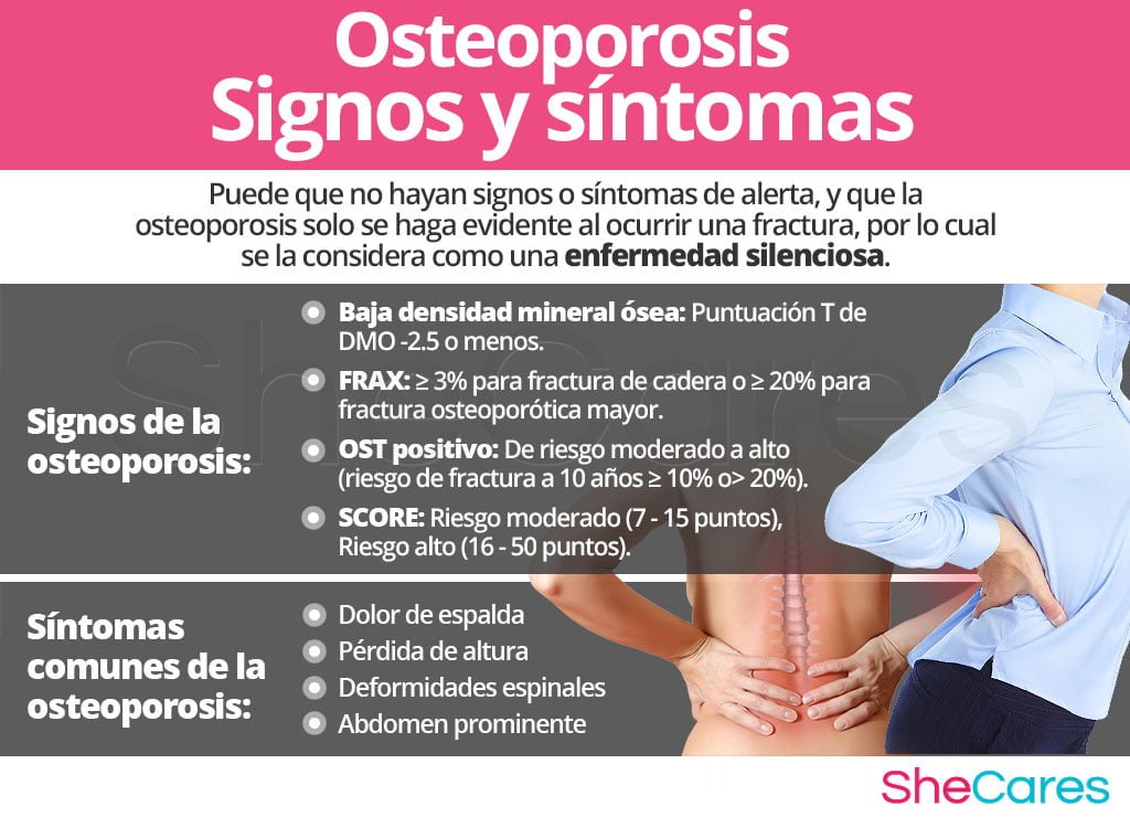 sintomas comunes de la osteoporosis en adultos identificacion