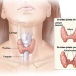 tratamientos efectivos para el hipotiroidismo y sus beneficios