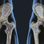 tratamientos efectivos para la osteoporosis en hombres y mujeres