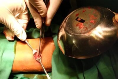 tratamientos efectivos y cuidados para el hiperparatiroidismo