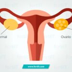 tratamientos para el sindrome de ovario poliquistico sop