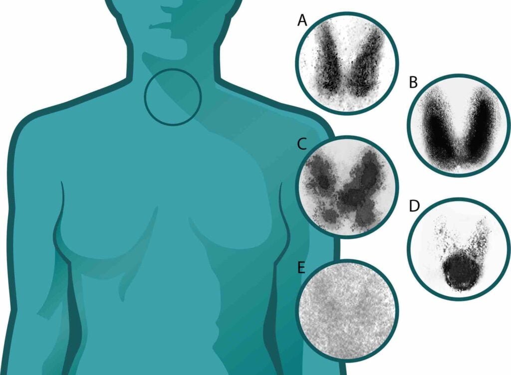 yodo radiactivo usos riesgos y lo que necesitas saber